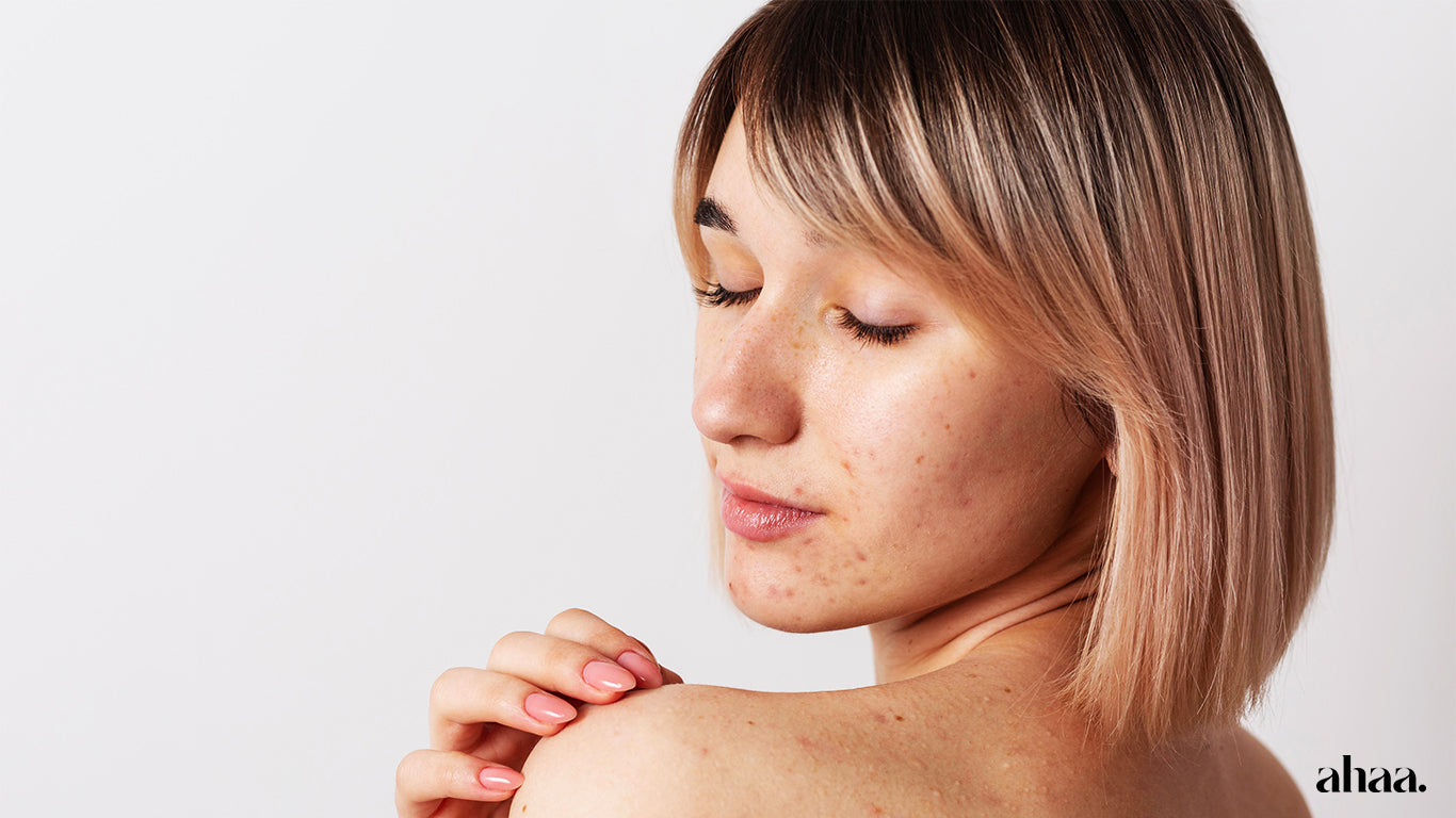 Acne: What it is, What Causes It, and How to Treat It