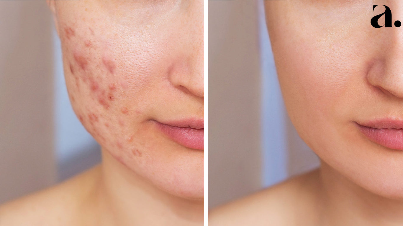 Before and after picture of a women using the best Acne Treatments and Products Exploring the Latest Trends in Skincare by Ahaa Skincare