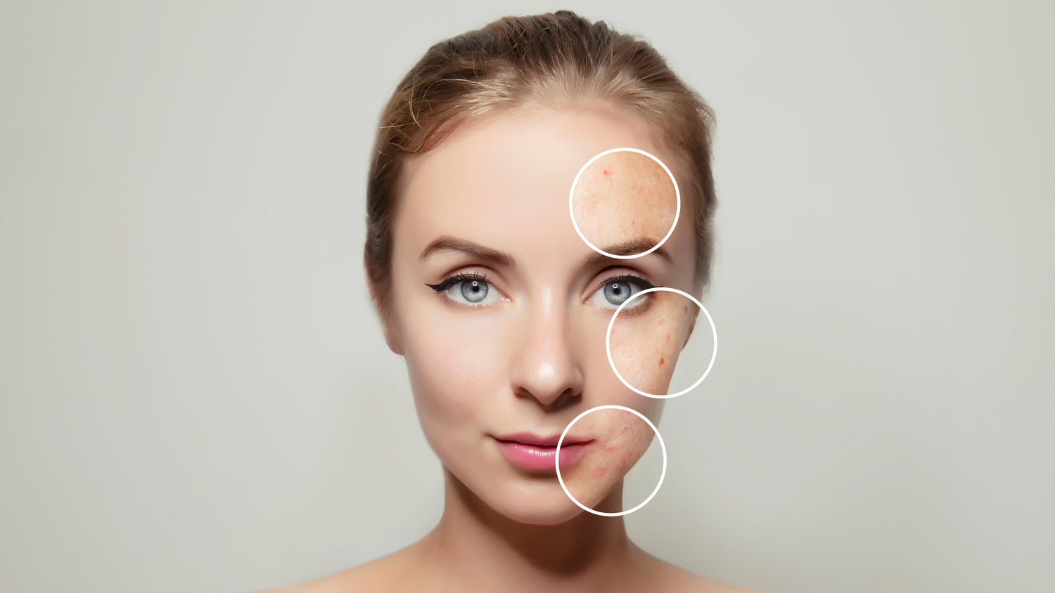 What You Need To Know About Hormonal Acne