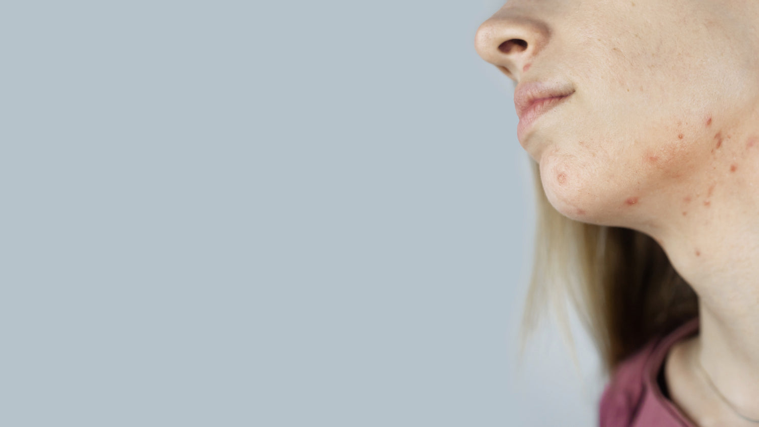 How to Heal Jaw Acne from the Inside-Out