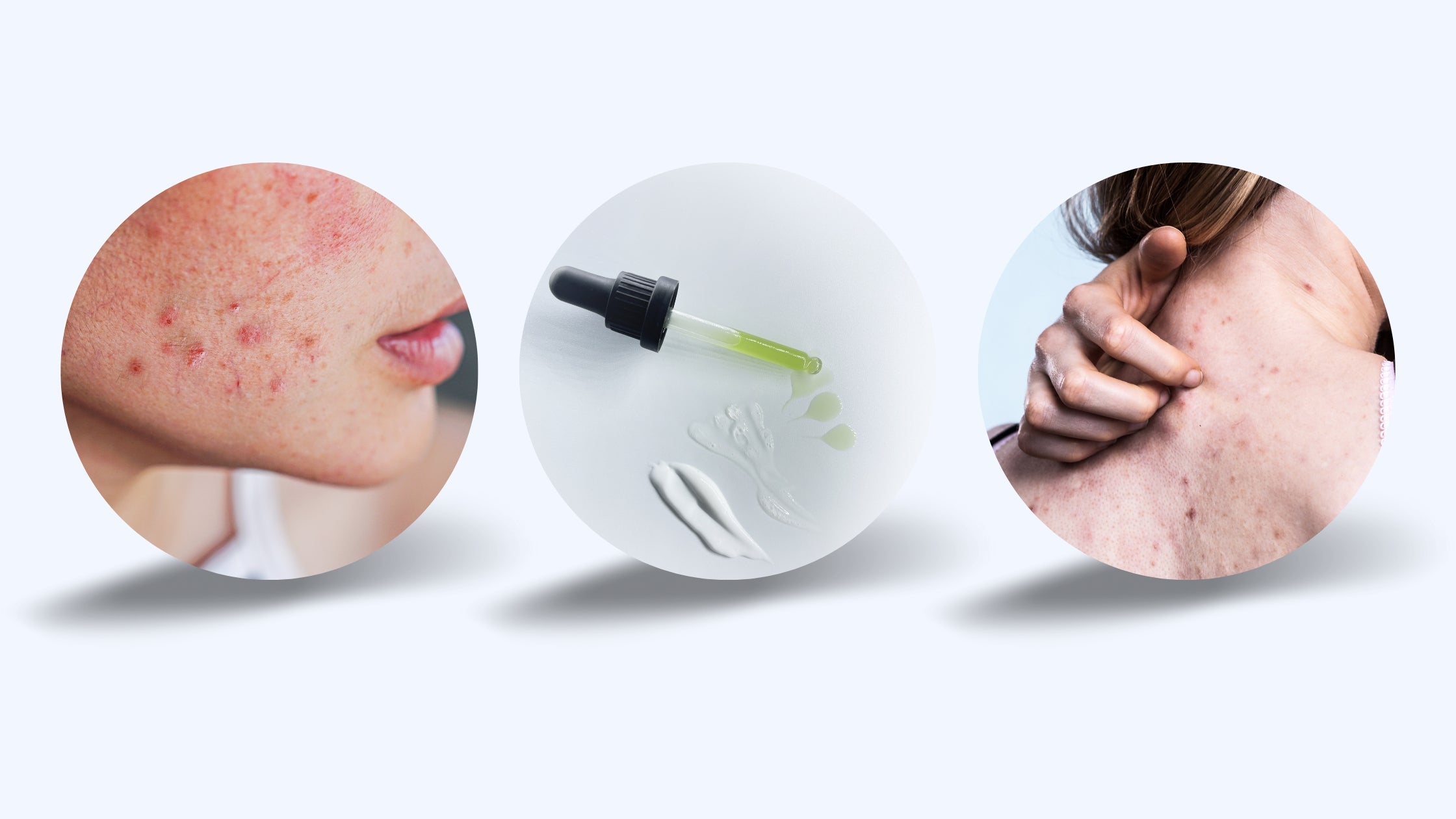 What is Fungal Acne?